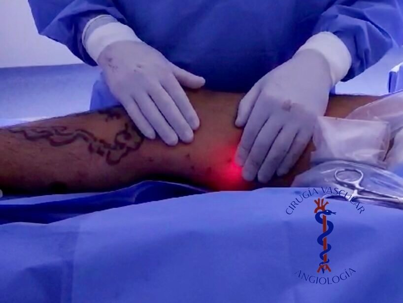 Screenshot Ablasion Laser de Safena