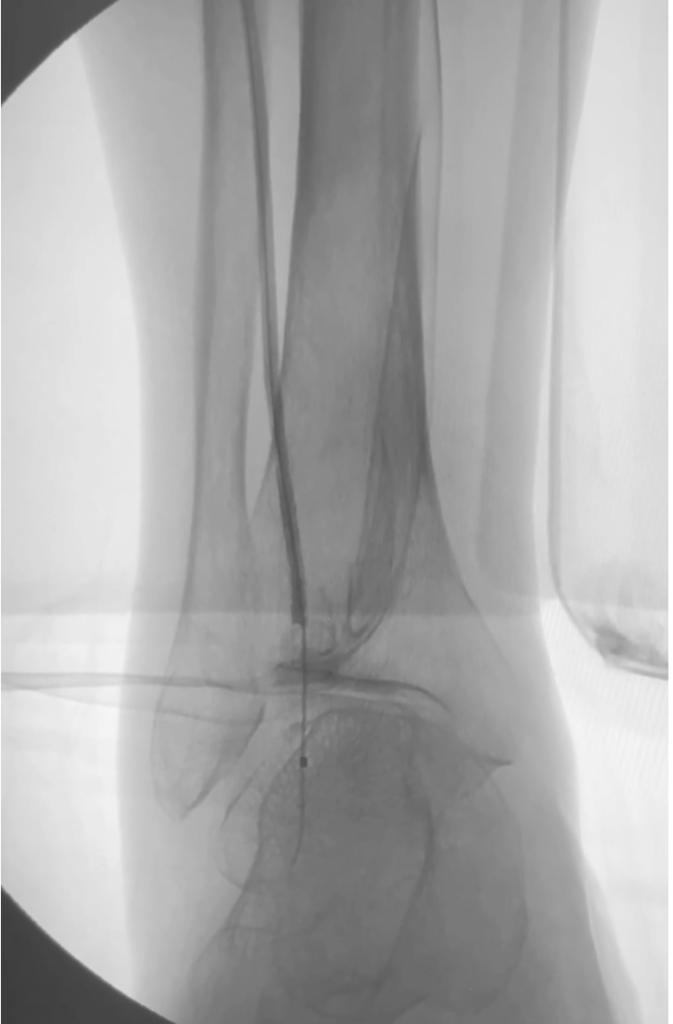 Captura de pantalla 2024-10-11 a la(s) 11.17.01 1 Angioplastia de arterias