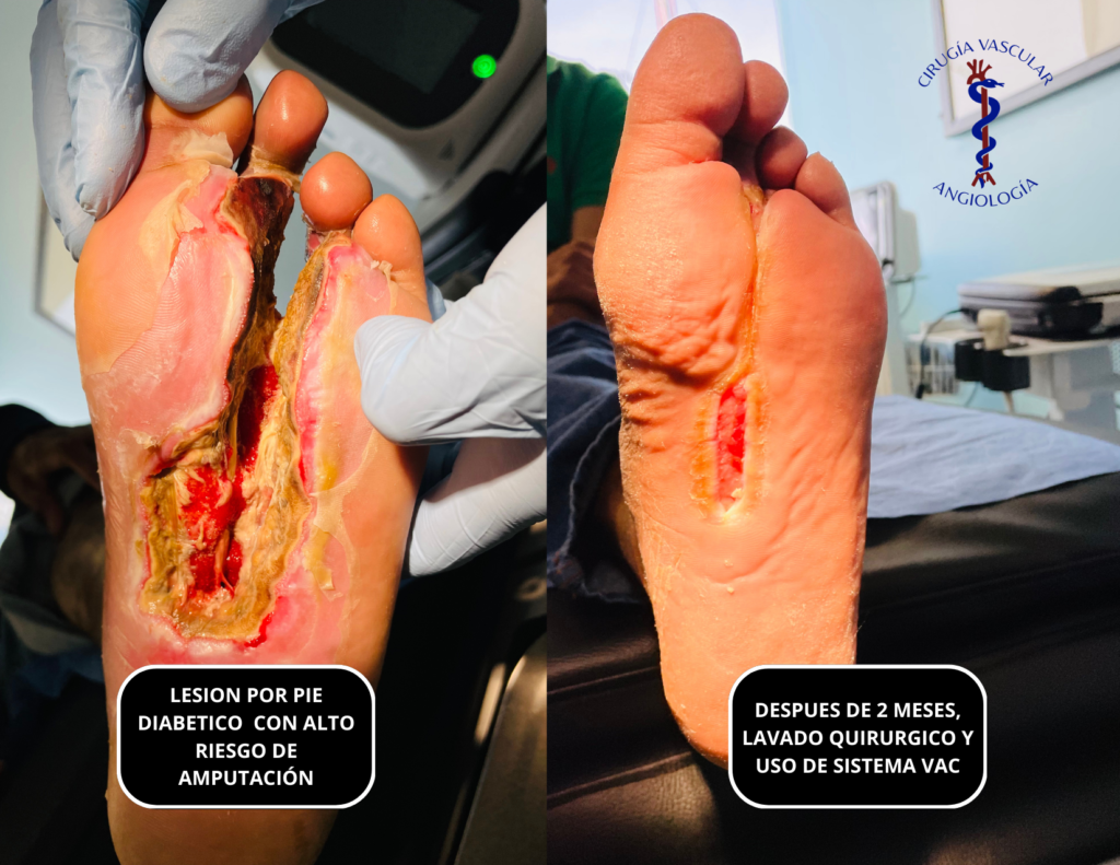 Pie diabetico 1.32 Salvamento del pie diabetico