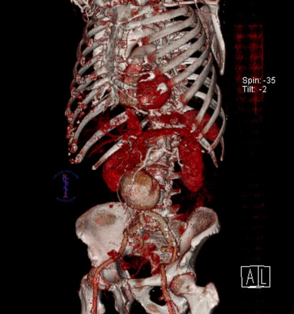 WhatsApp Image 2024-10-04 at 13.55.19 Aneurisma de aorta abdominal