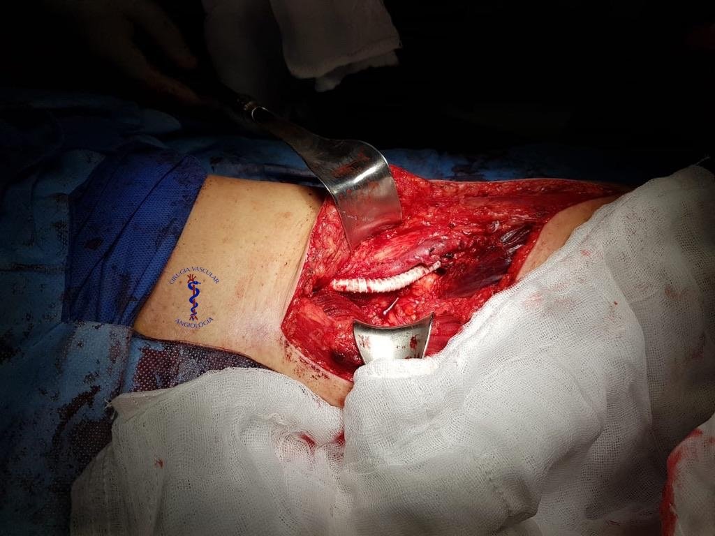 WhatsApp Image 2024-10-04 at 13.55.38 By pass para salvamento de las extremidades