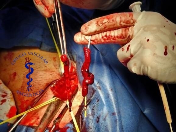 c858bbd5-b19c-48a4-96de-075b8673984d Trombectomia arterial y venosa