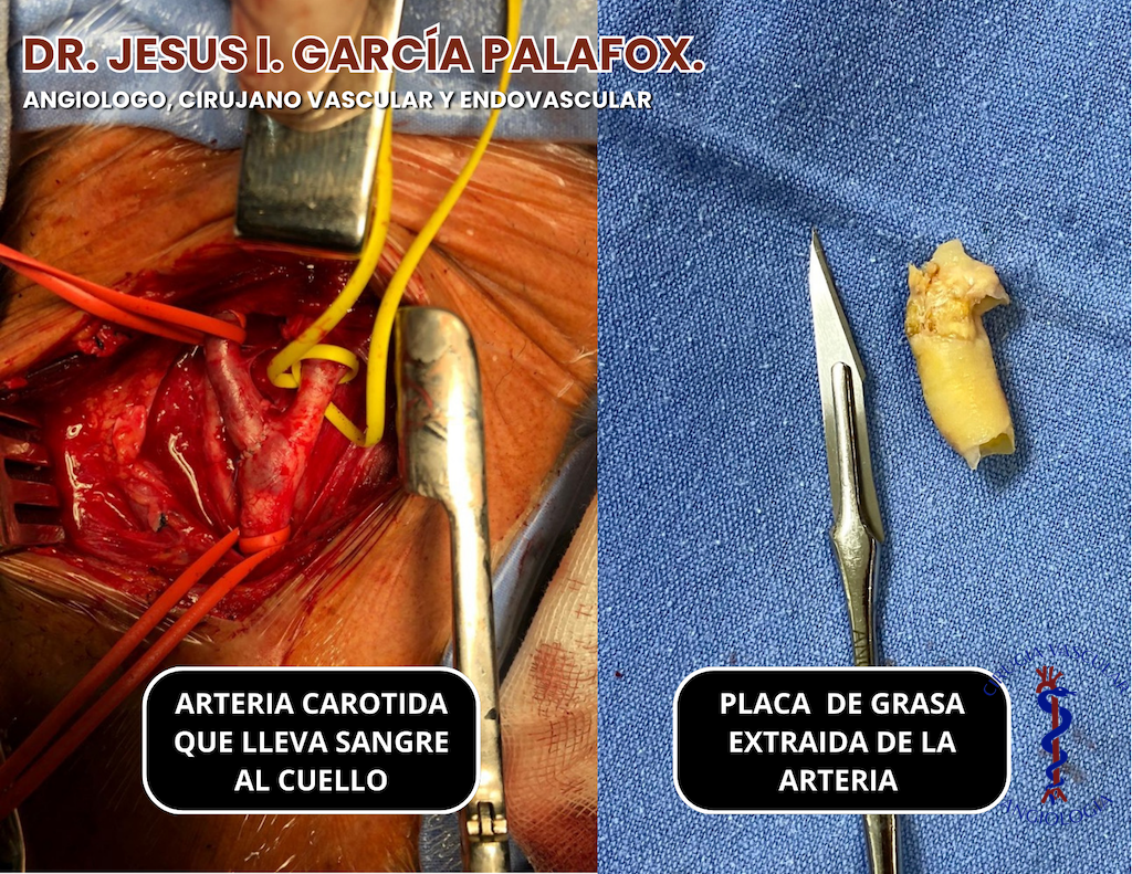 endarterectomia carotidea Edarterectomia carotidea